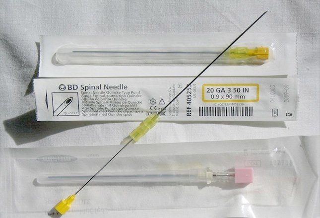 Hidrocefalia después de punción lumbar Hidrocefalia después de punción lumbar