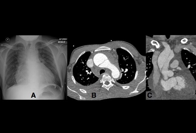 tomografia pulmonar con contraste