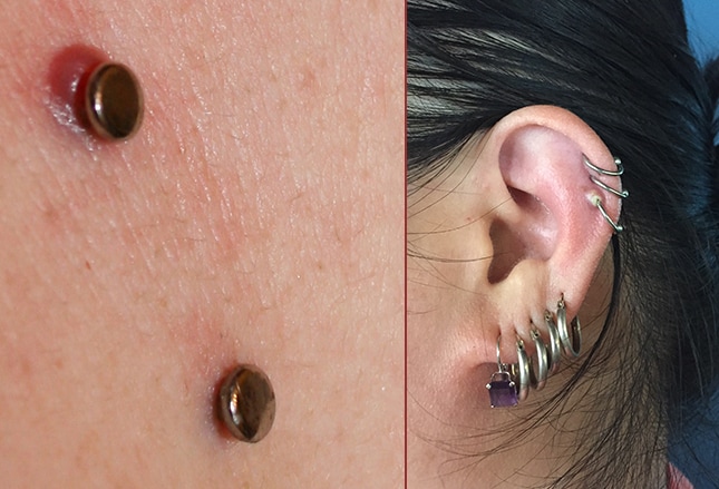 perforación dermatosis emedicina diabetes