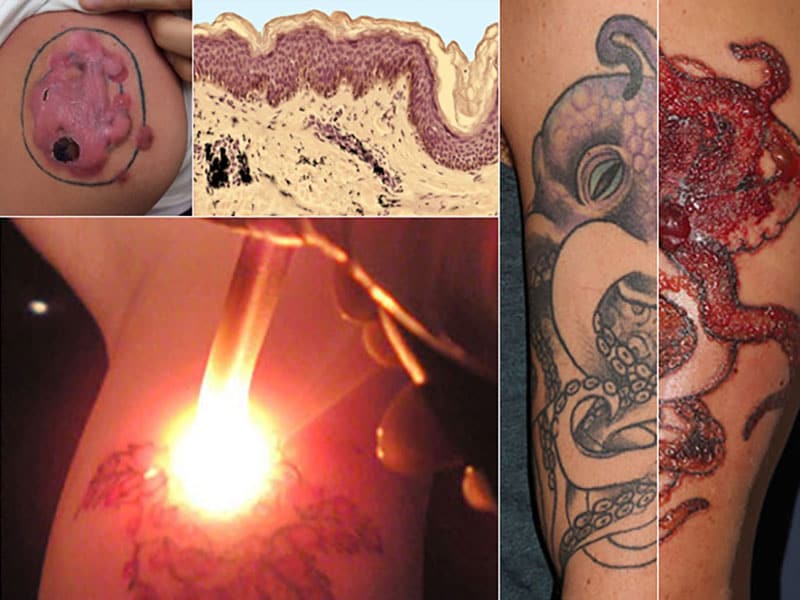 Reacciones cutáneas a tatuajes: alergias e infecciones