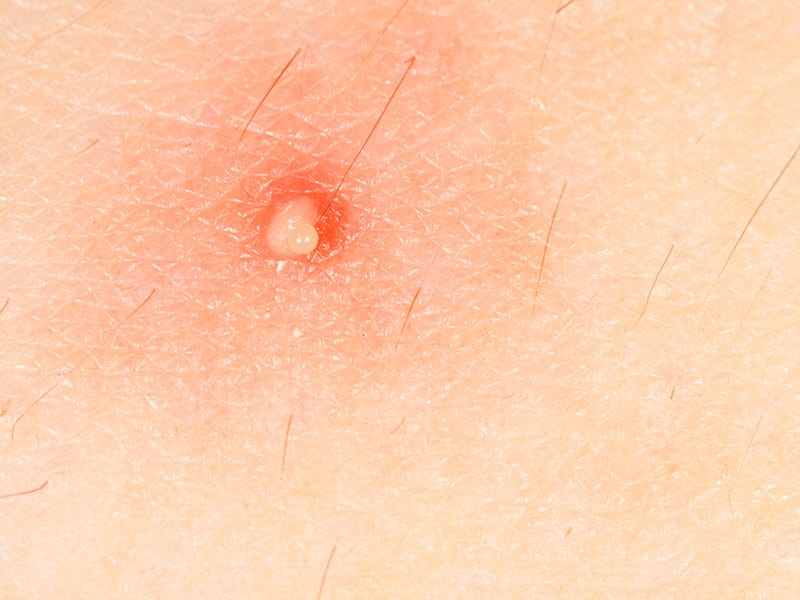 Antibióticos mejoran los resultados a corto plazo en los abscesos simples