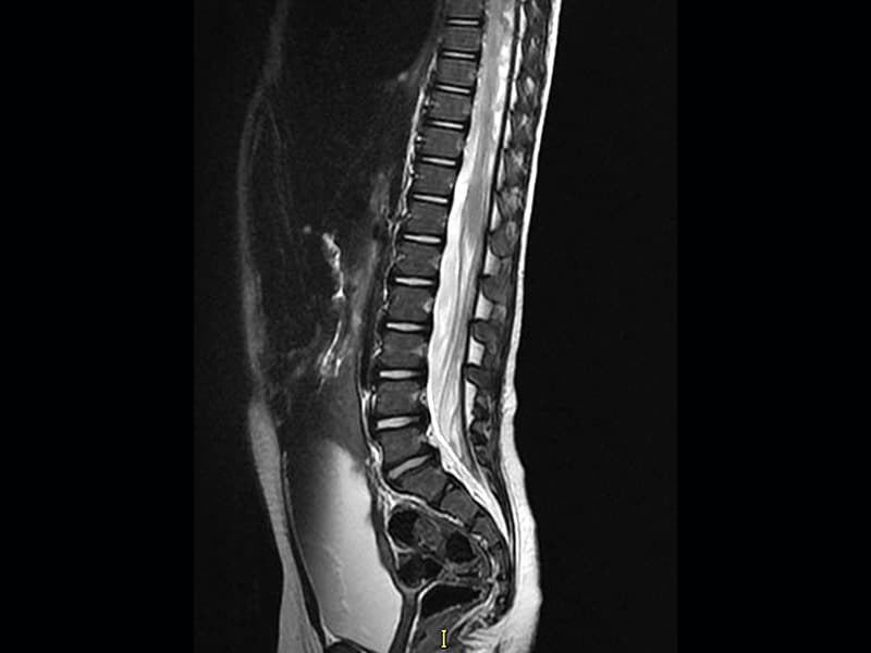 causas de polineuropatía por cidp en diabetes causas de polineuropatía por cidp en diabetes