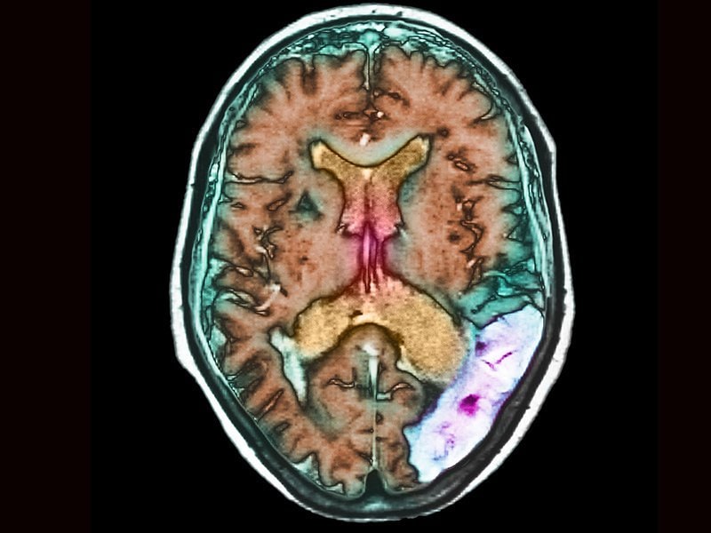 accidente cerebrovascular isquémico vs hemorrágico resonancia magnética