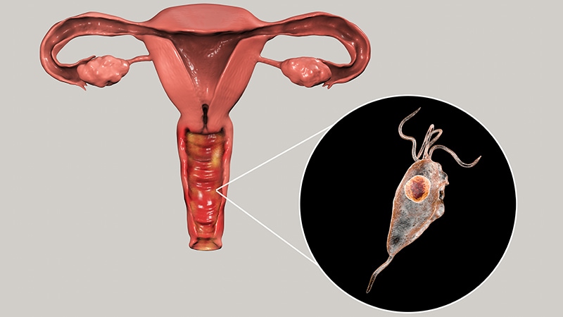 tricomoniasis en hombres y mujeres