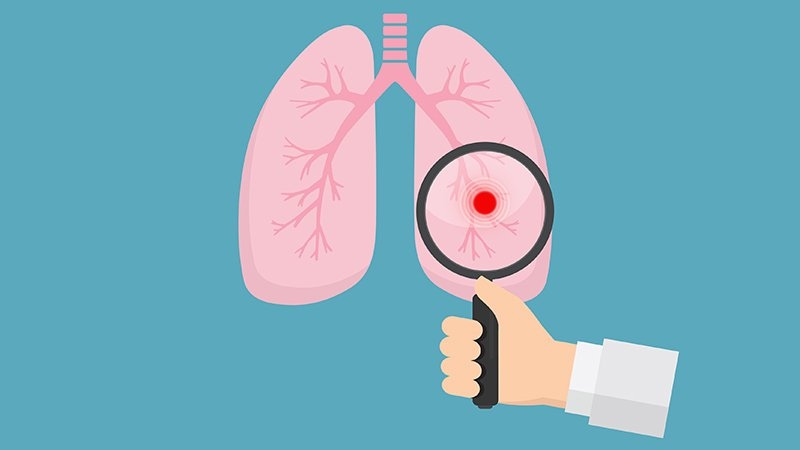 Uno de cada 4 pacientes con cáncer de pulmón de células no pequeñas estará vivo a los 5 años después de recibir pembrolizumab