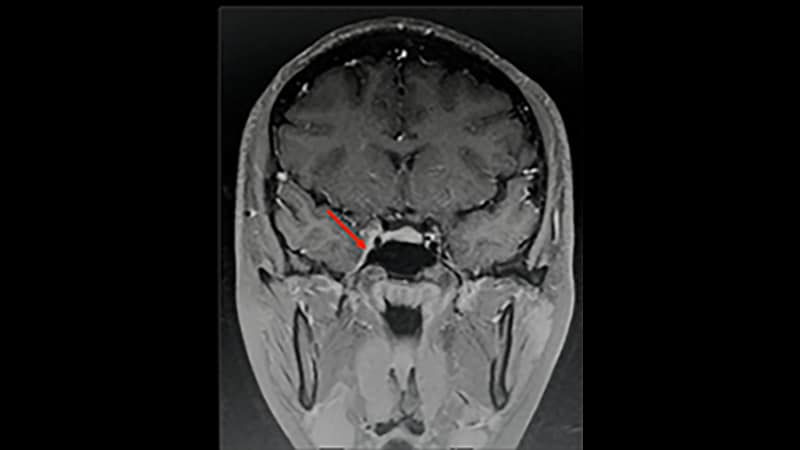 Punción lumbar presión ocular Punción lumbar presión ocular