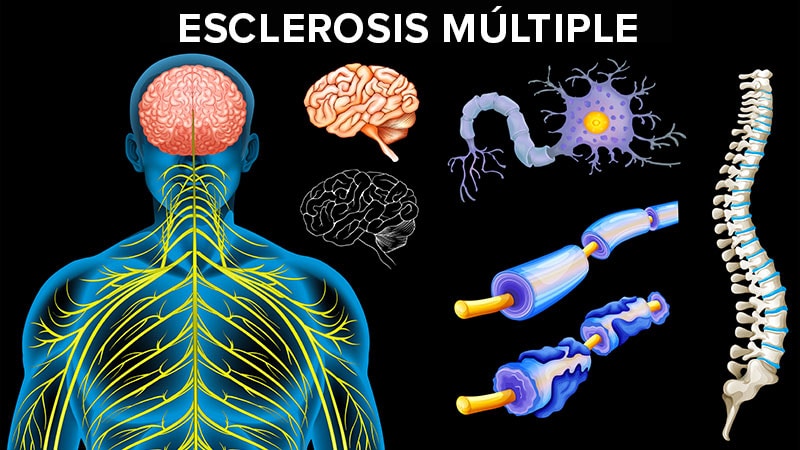 Mini-Examen Clínico: ¿Qué tanto sabe de esclerosis múltiple?