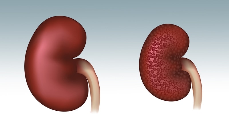Finerenona: oportunidad de optimizar la atención en diabetes con o sin enfermedad renal