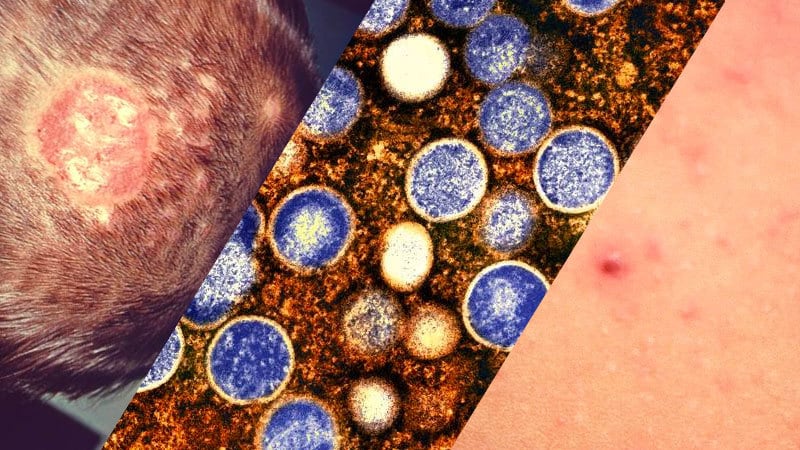 Casos Sarna: Los dermatólogos advierten de que los tratamientos contra la  sarna están perdiendo eficacia