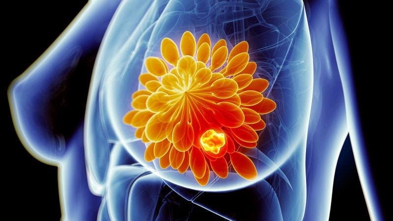 PALLAS: Sin beneficio al agregar palbociclib a la terapia en cáncer de mama