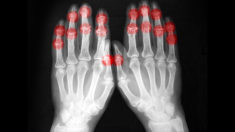 Perspectivas sobre la artritis reumatoide de difícil tratamiento