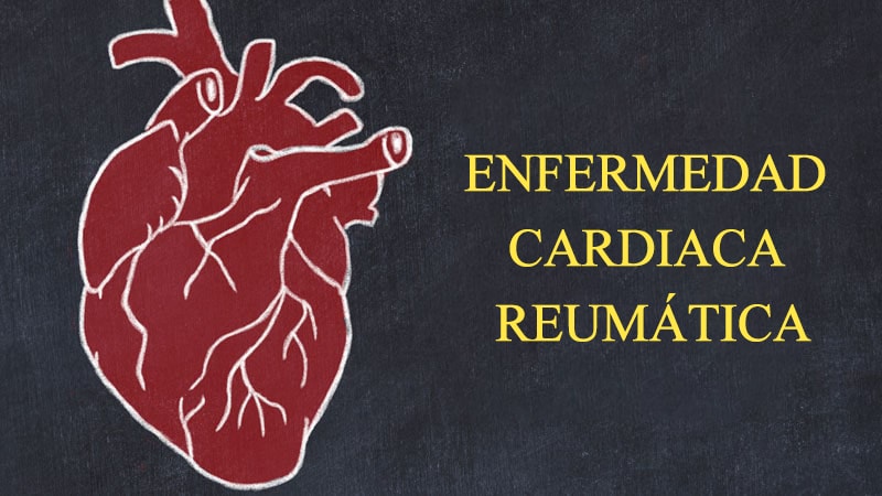 La penicilina lentifica la progresión de la cardiopatía reumática latente – Medscape
