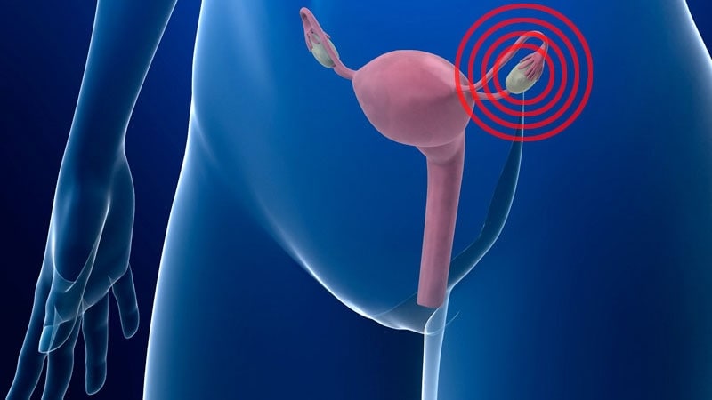 Ooforectomía (extirpación quirúrgica de los ovarios) - Mayo Clinic