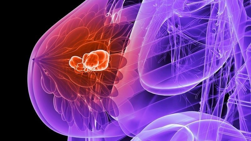 EMERALD: reducción en 30% del riesgo de muerte en cáncer de mama positivo a receptores hormonales