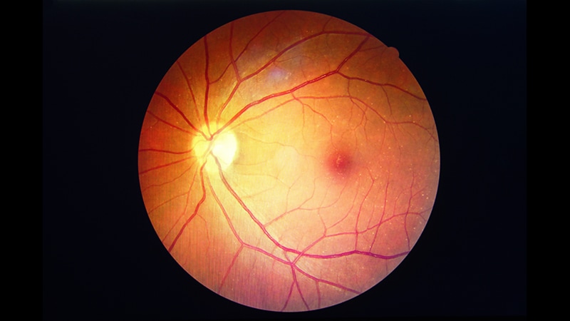Microperimetría de retina y manejo del colesterol se perfilan como líneas de detección y abordaje de la diabetes de tipo 2