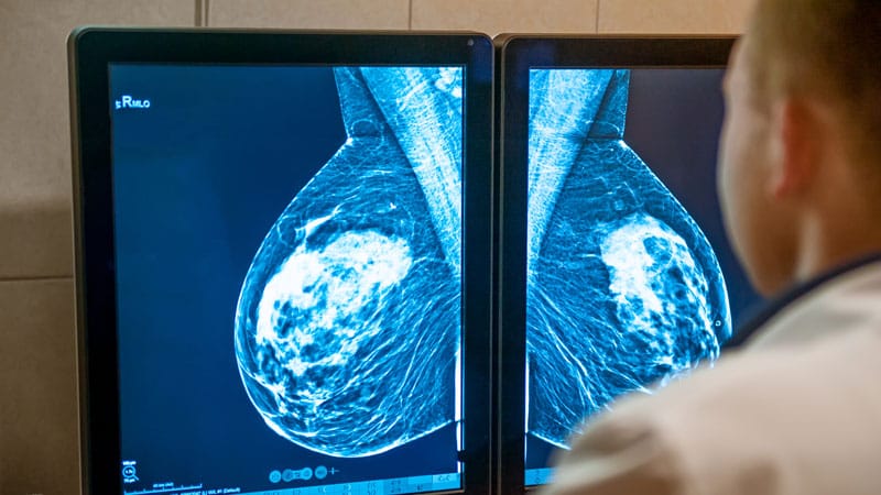 メキシコの乳がん生存者の二次腫瘍スクリーニングの下