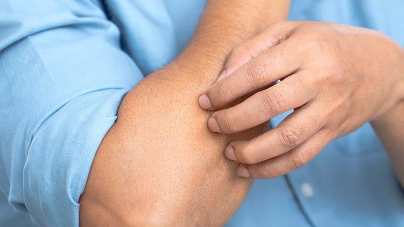 Se recomienda un enfoque gradual para pacientes con delirio de parasitosis