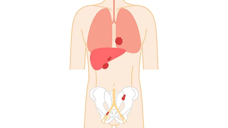 Talazoparib con enzalutamida mejora sobrevida en cáncer de próstata ...