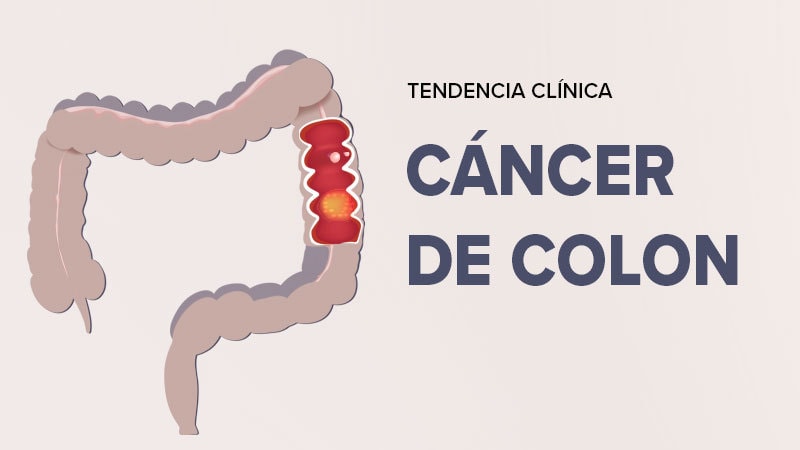cancer de colon foro îndepărtarea papilomelor de sărat