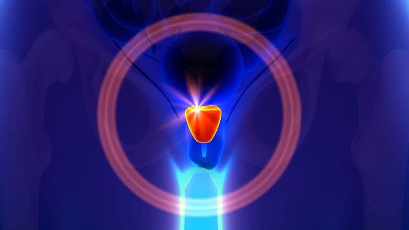 Hito en cáncer de próstata resistente a castración metastásico: radiofármaco aumenta la sobrevida