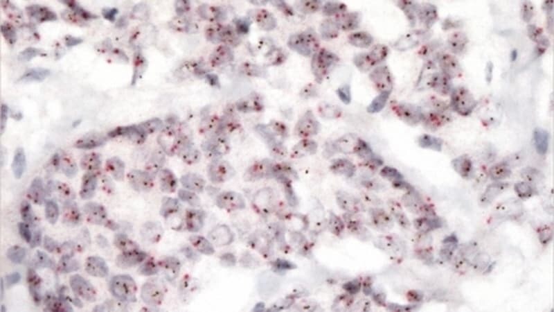 Cáncer de mama metastásico HER2 positivo: trastuzumab deruxtecán frena la progresión del tumor en cerca de 76% de las pacientes