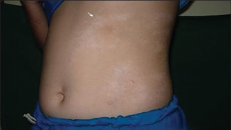 La morfea pediátrica como una enfermedad sistémica y crónica