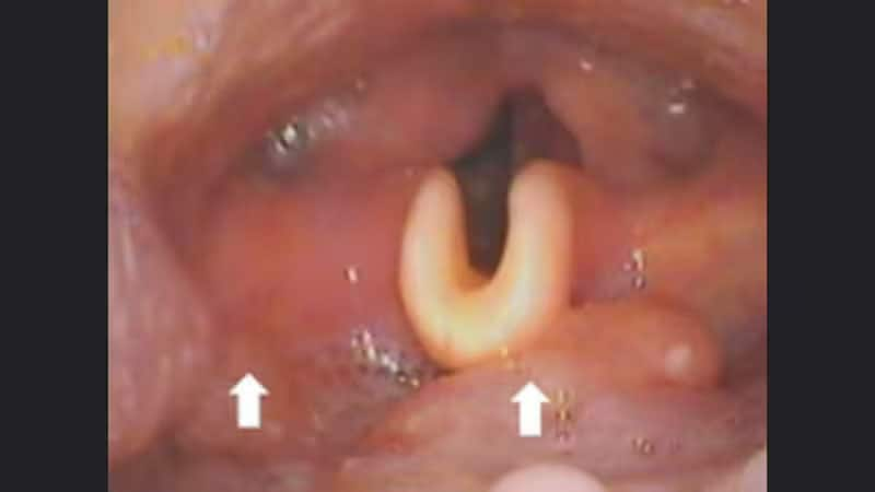 Standard chemoradiation in oropharyngeal cancer associated with human papillomavirus?