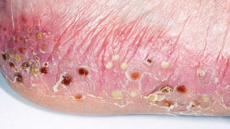 psoriasis pustulosa leve