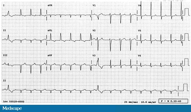 Extrasystole Ecg