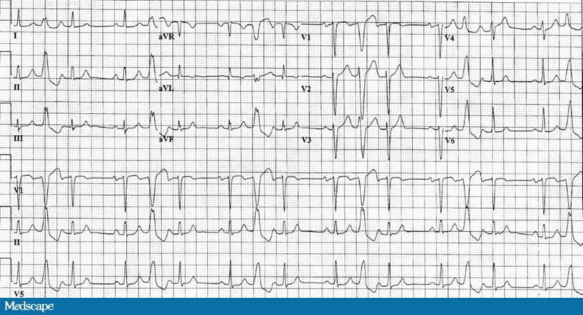 ECG : Rythme sinusal, mais quoi d'autre