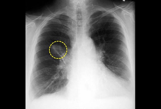 opacité nodulaire poumon - quesqu un nodule au poumon