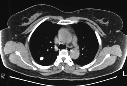 Nodule pulmonaire isolé : est-ce un cancer du poumon ? | Medscape