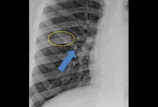 Nodule pulmonaire isolé : est-ce un cancer du poumon ? | Medscape