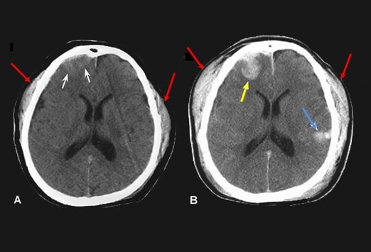 Diaporama : le scanner cérébral sans injection | Medscape