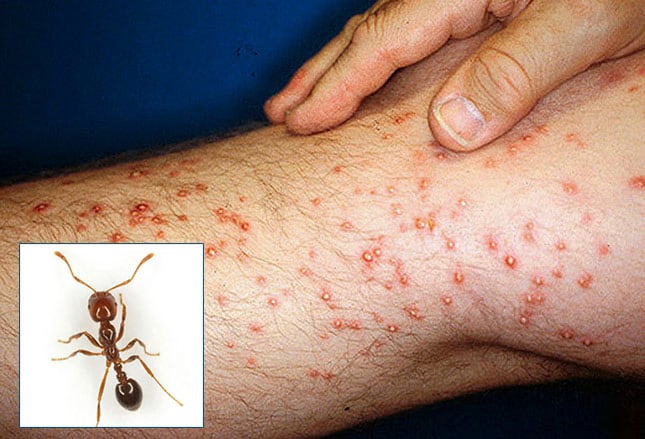 Reconnaitre Et Traiter Les Piqures D Insectes Reconnaitre Et Traiter Les Piqures D Insectes