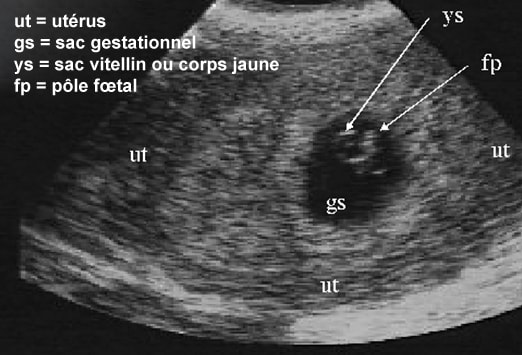 Deuxième échographie de la grossesse : symptômes, traitement, définition 