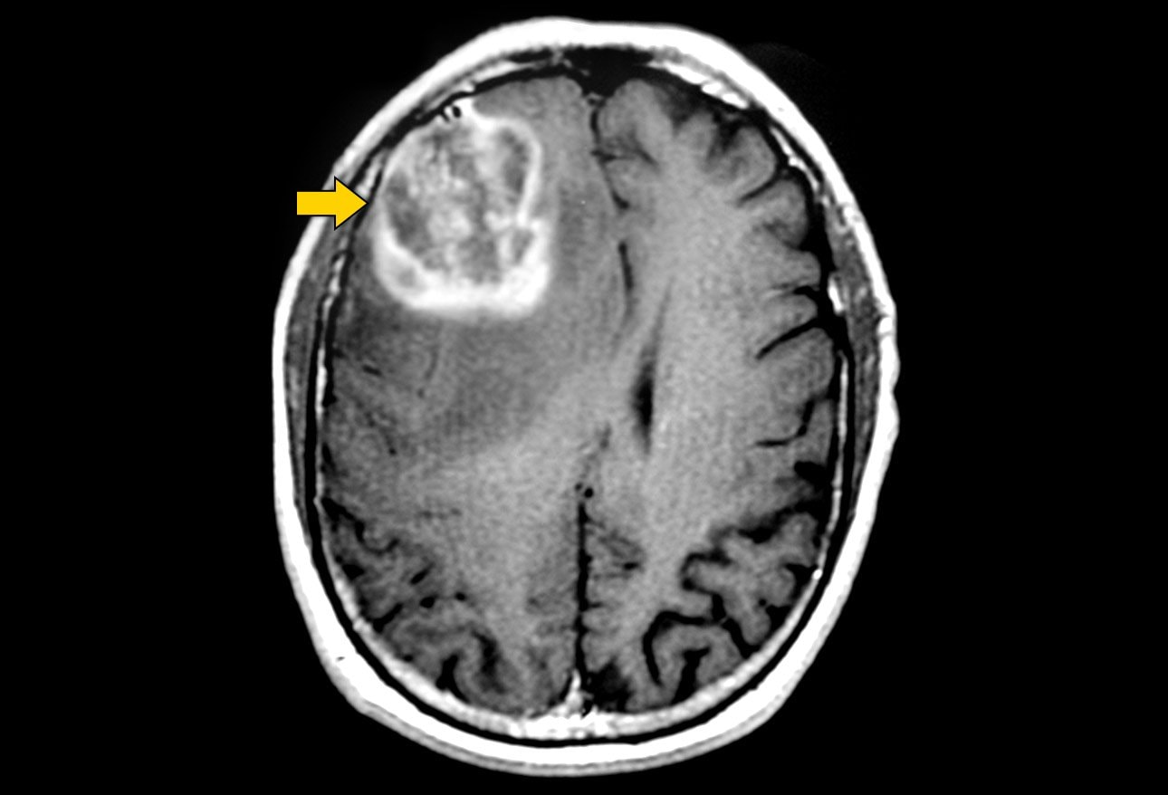 Diaporama : les tumeurs cérébrales pédiatriques