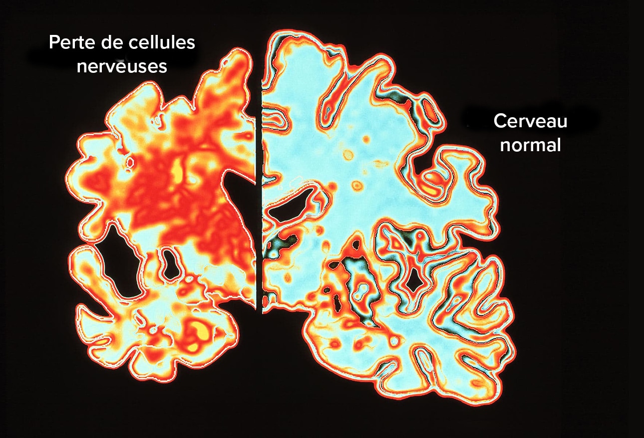 En images ces pathologies ou activités qui modifient le cerveau