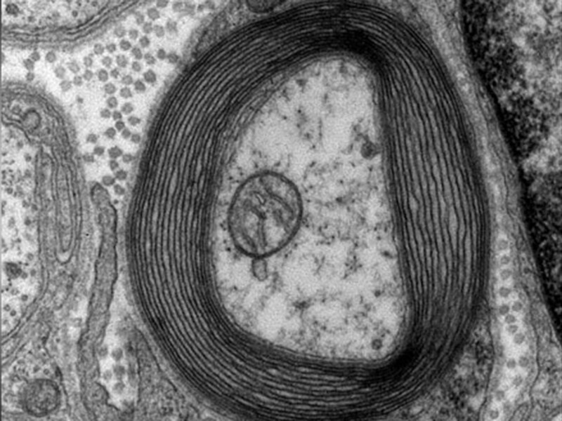 Quiz sclérose en plaques : identification, diagnostic différentiel et prise en charge