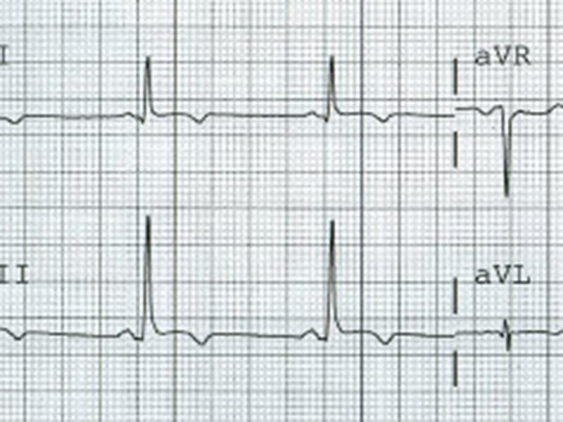 Que penser de la repolarisation sur cet ECG