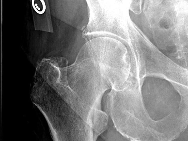 Cas clinique: fracture de hanche bilatérale chez un homme âgé