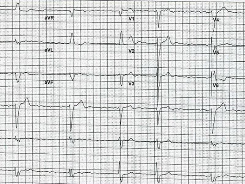 ECG: une histoire de fibrillation atriale
