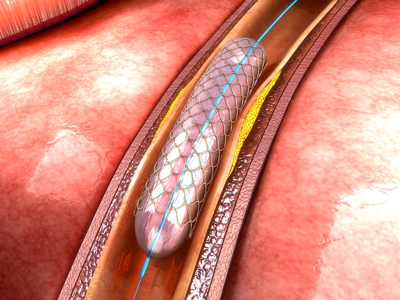 AOD et angioplastie : leçons pratiques de l’étude PIONEER
