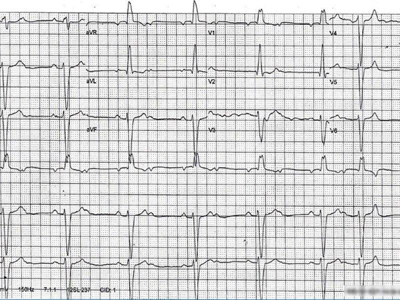 Quiz : un ECG enregistré pendant le sommeil