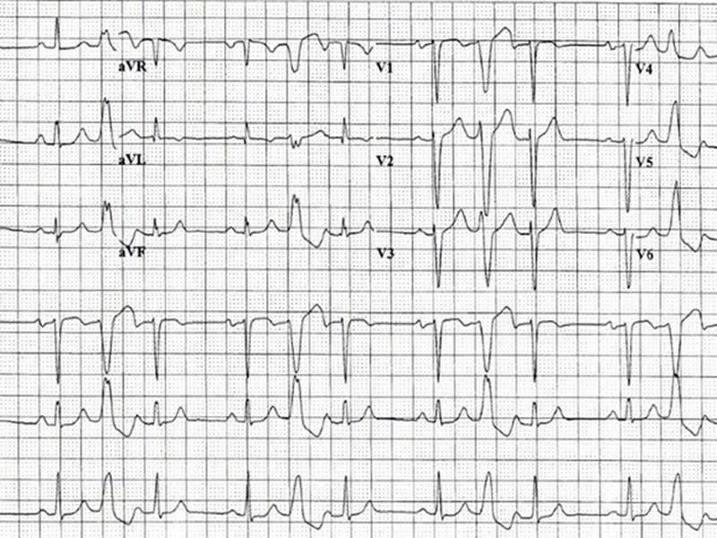 ECG : Rythme sinusal, mais quoi d'autre ? - Page 2