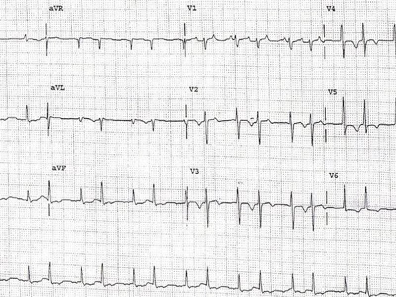 ECG : une crise hypertensive