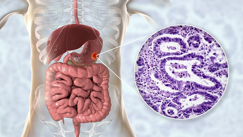 Cancer de l’estomac: nouveau standard de chimiothérapie péri-opératoire