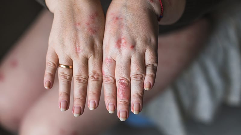 Maladies inflammatoires chroniques un risque CV variable