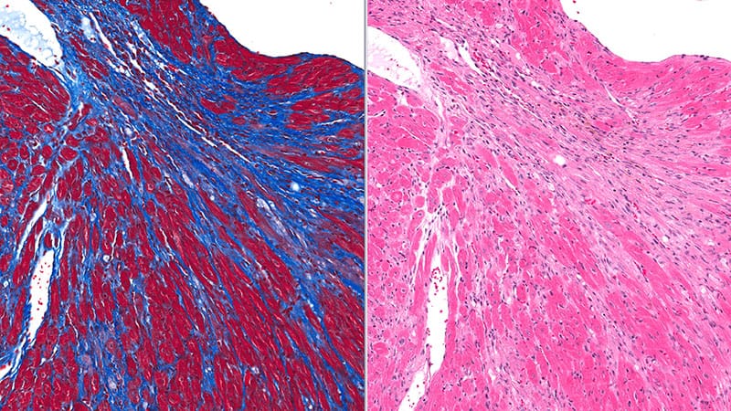 FA persistante : la technique d'ablation de la fibrose guidée par IRM ...