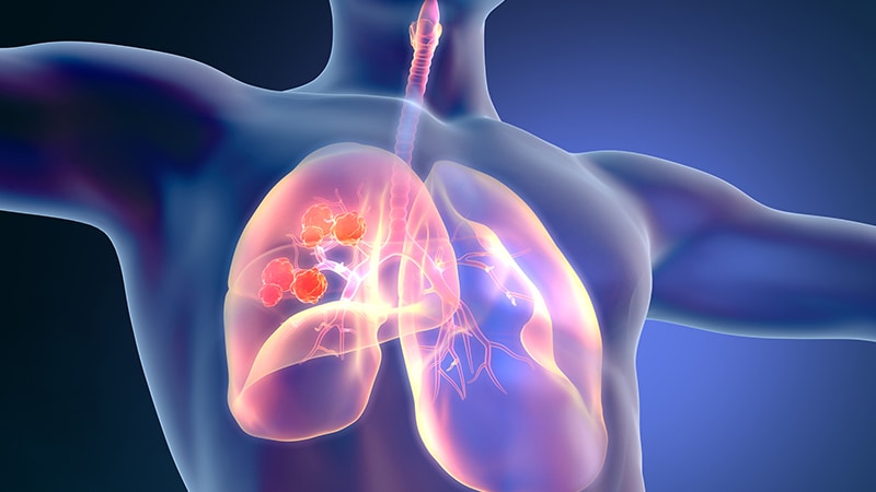 Cancer du poumon : les études marquantes sélectionnées par le Pr Marie Wislez